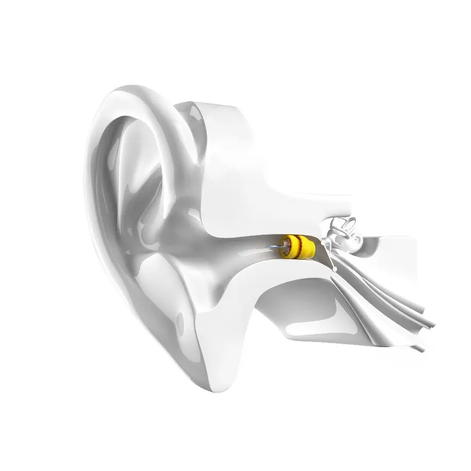 A 3D-rendered white human ear model with a small yellow and gray electronic device inserted into the ear canal, and wires extending outward from the device.